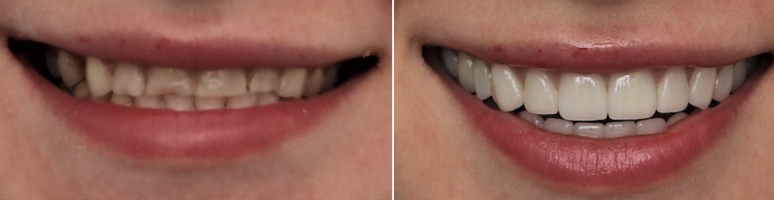 Фото до и после - Виниры: секрет идеальной улыбки