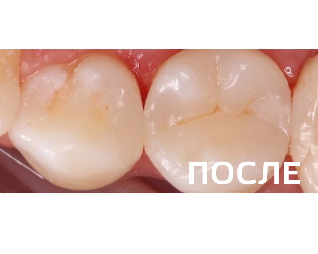 Лечение кариеса