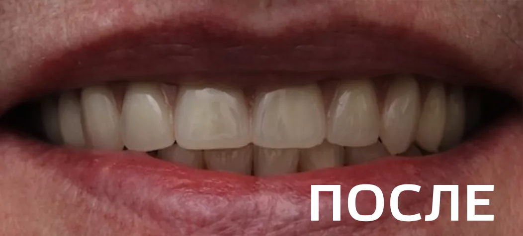 Фото после - Ортопедическое восстановление зубных рядов верхней и нижней челюстей  