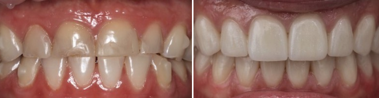 Фото до и после - Удаление молочных зубов