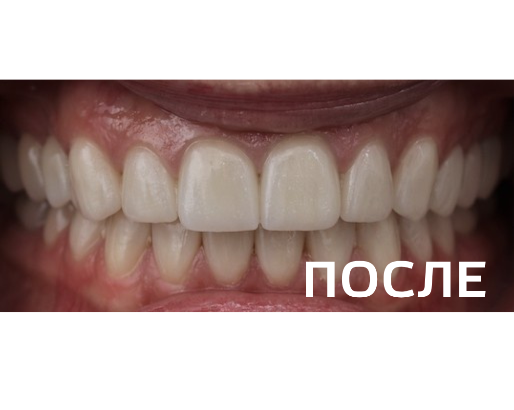 Комплексное ортопедическое восстановление зубных рядов 