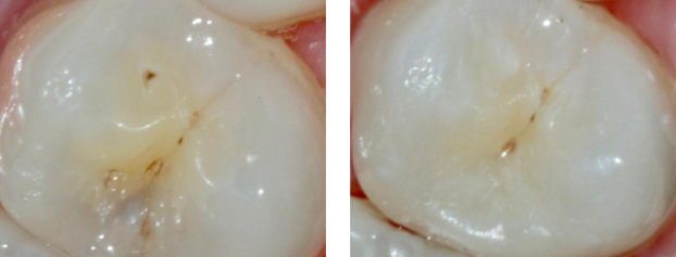 Фото до и после - Лечение контактного кариеса премоляра