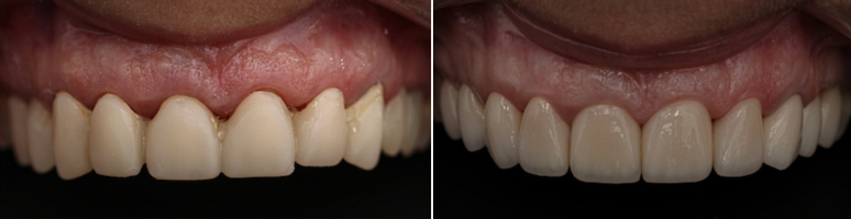 Фото до и после - Коронки на молочные зубы