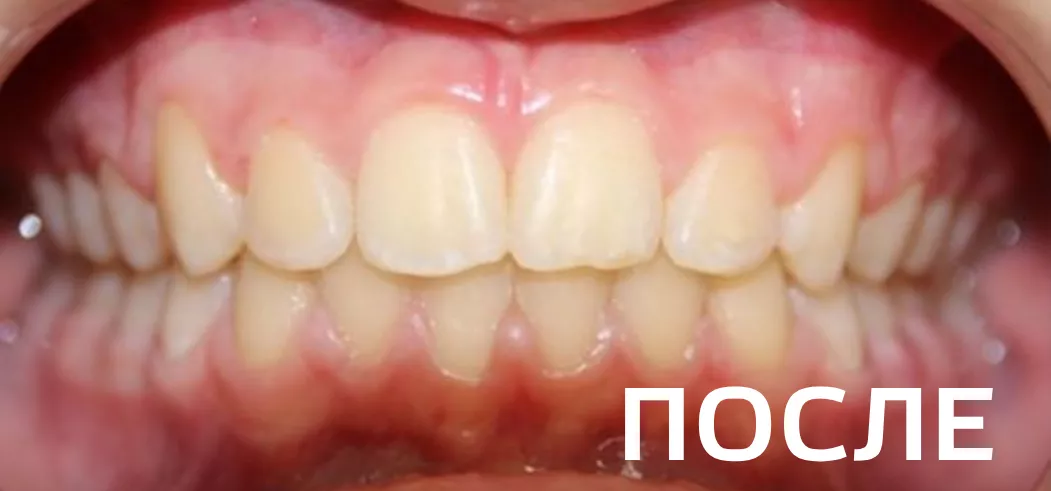 Фото после - Исправление прикуса, выравнивание зубов