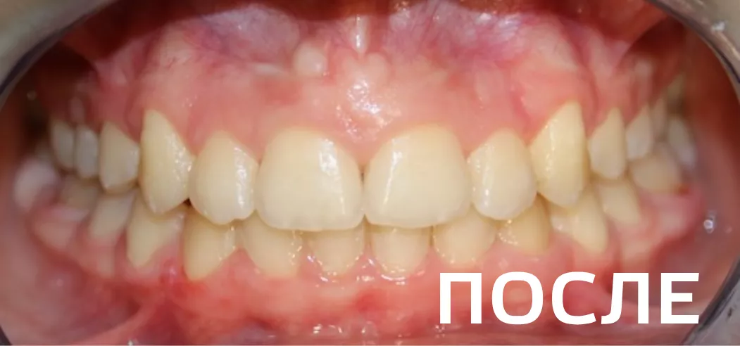 Фото после - Исправление прикуса, выравнивание зубов