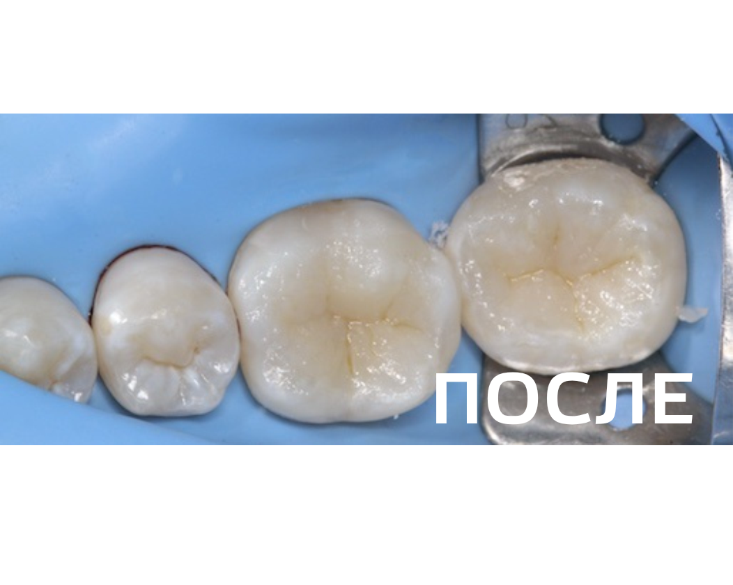 Лечение кариеса 