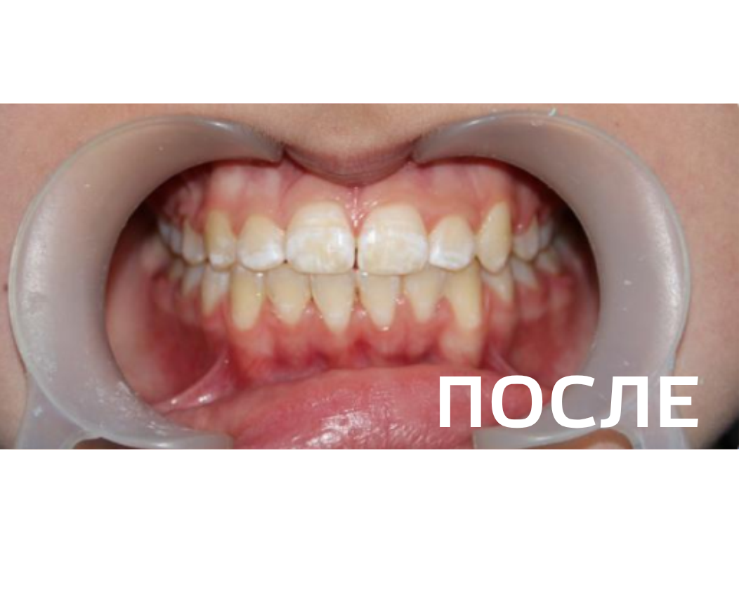 Исправление прикуса, выравнивание зубов