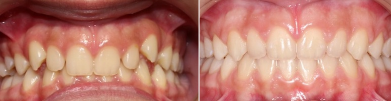 Фото до и после - Исправление прикуса, выравнивание зубов