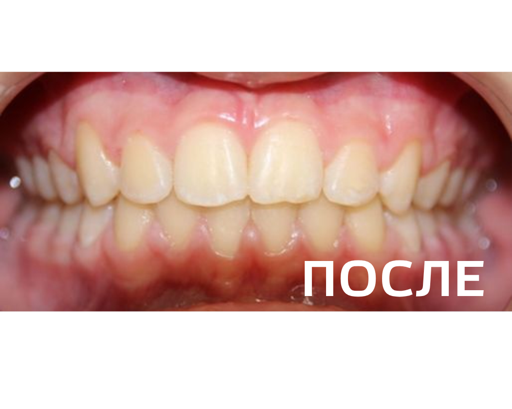 Исправление прикуса, выравнивание зубов