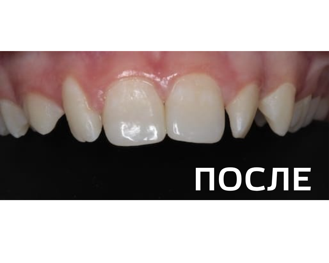 Реставрация зубов