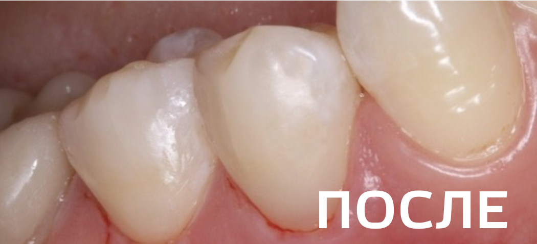 Фото после -  Лечение клиновидных дефектов