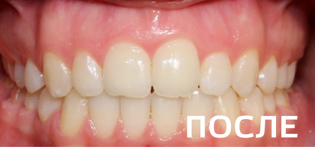 Исправление прикуса, выравнивание зубов