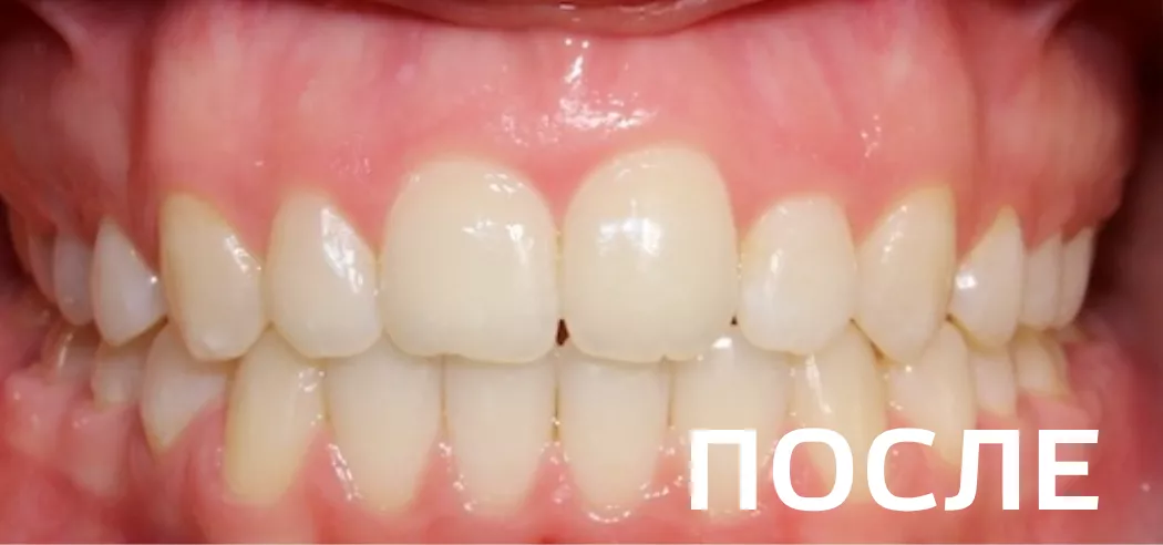 Фото после - Исправление прикуса, выравнивание зубов