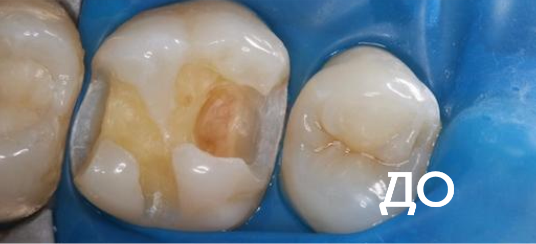 Фото до - Лечение кариеса