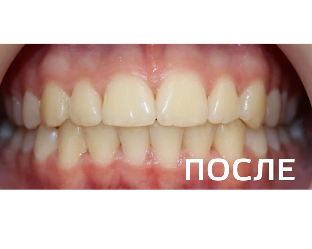 Исправление прикуса, выравнивание зубов