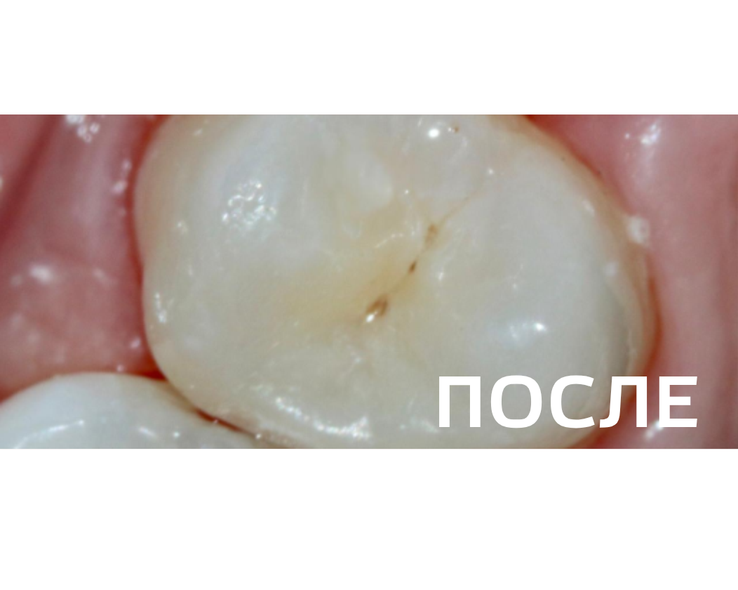 Лечение контактного кариеса премоляра