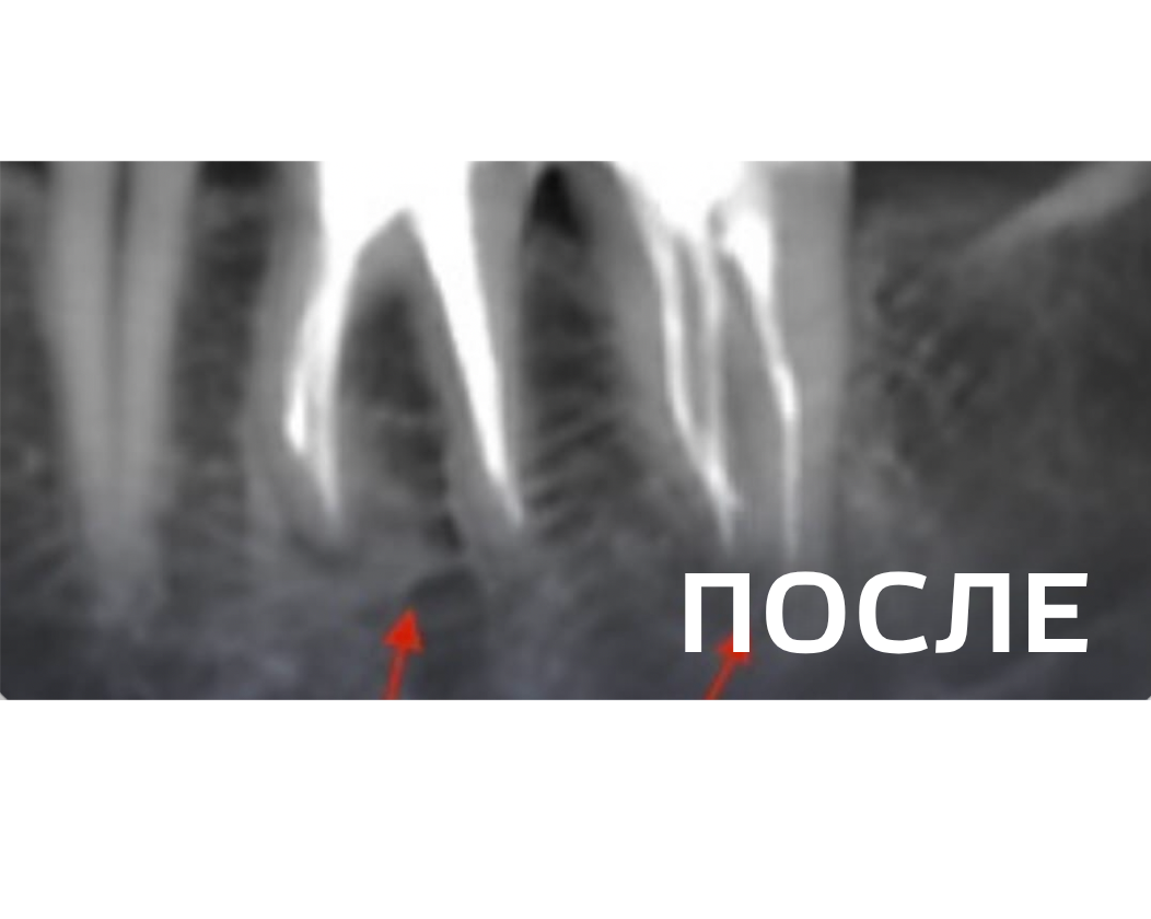 Лечение периодонтита