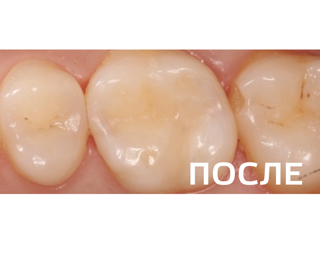 Лечение кариеса дентина