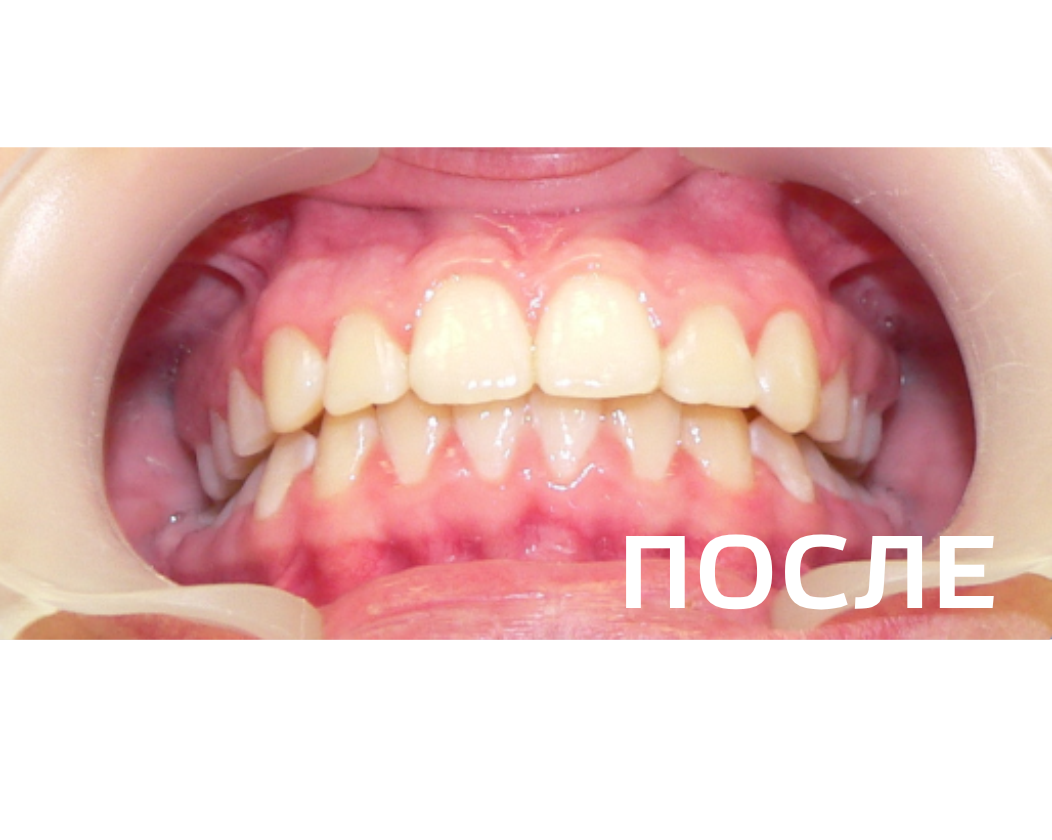 Исправление прикуса, выравнивание зубов