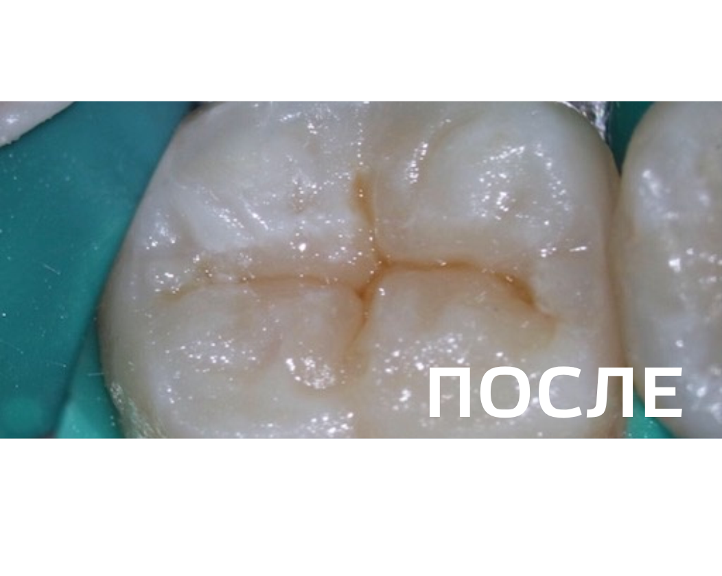 Лечение фиссурного кариеса нижнего моляра