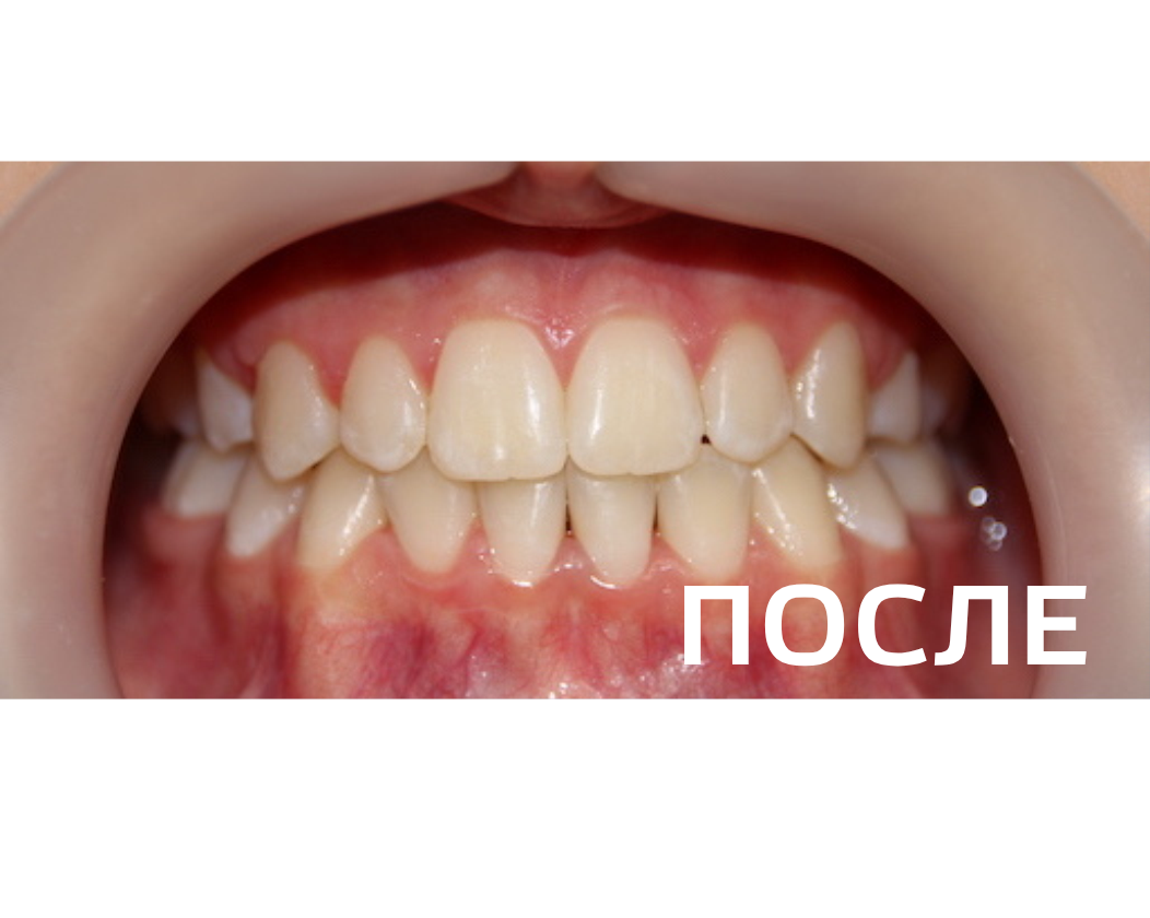 Исправление прикуса, выравнивание зубов
