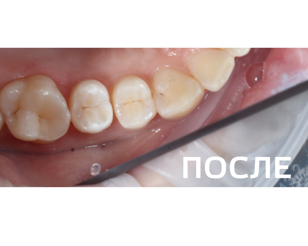 Лечение кариеса