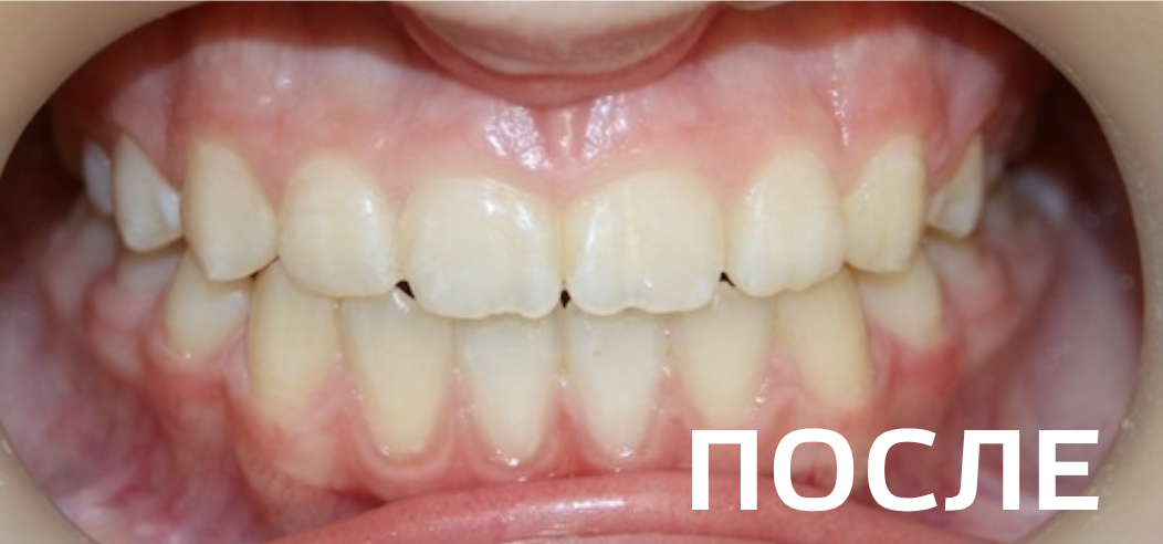 Фото после - Исправление прикуса, выравнивание зубов