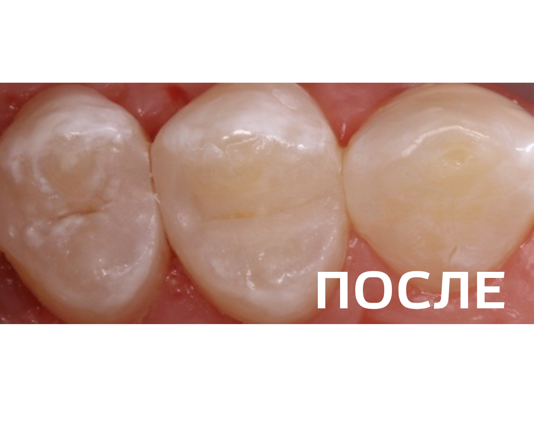 Лечение кариеса 