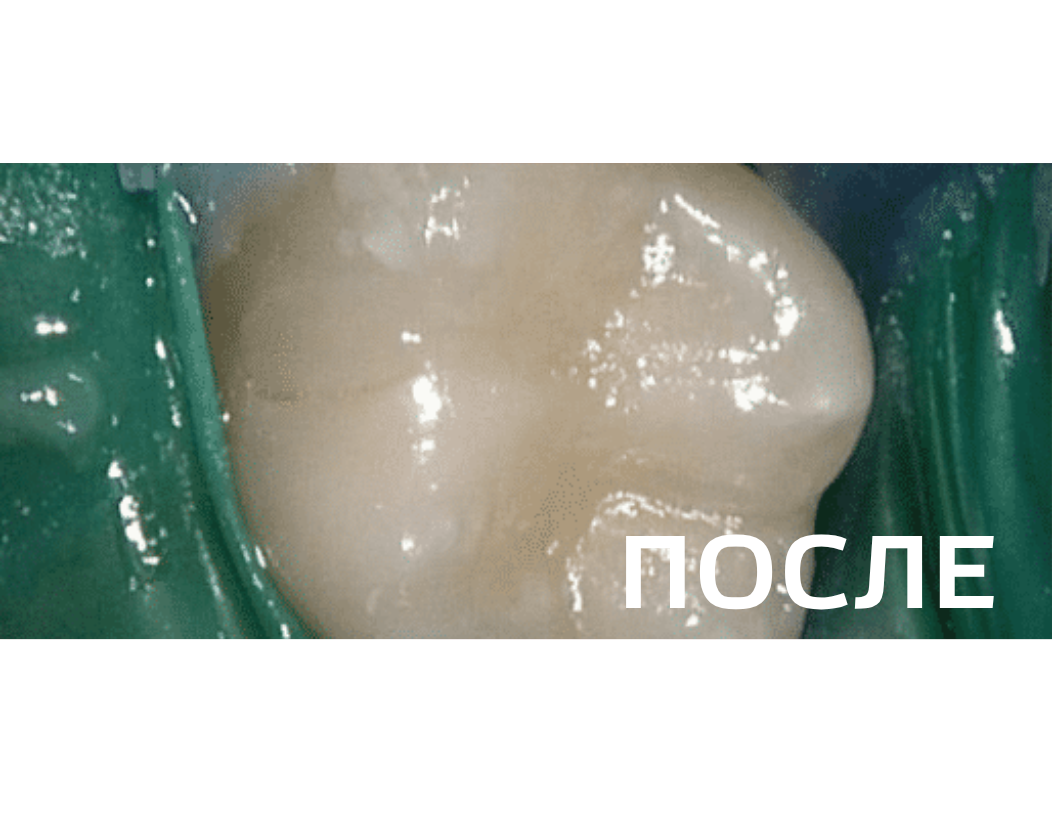 Лечение кариеса дентина