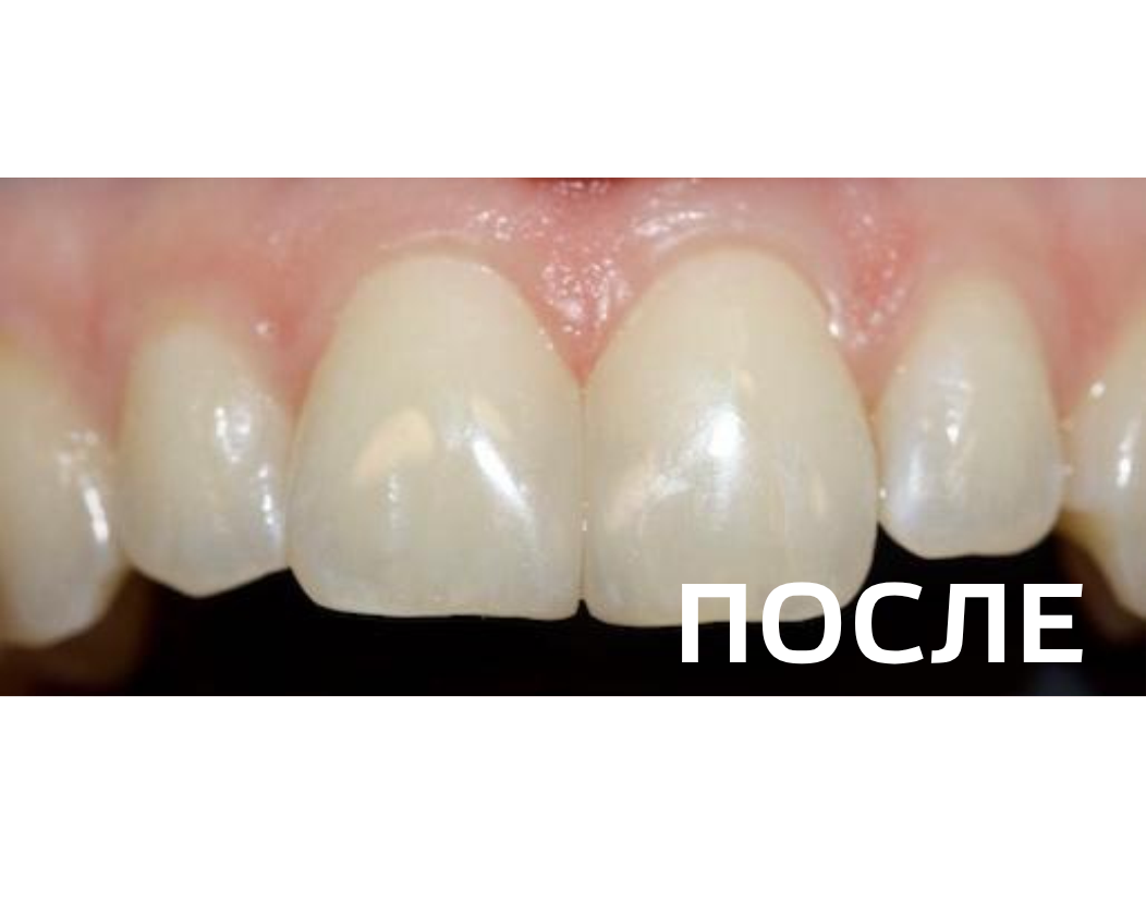 Замена несостоятельных реставраций