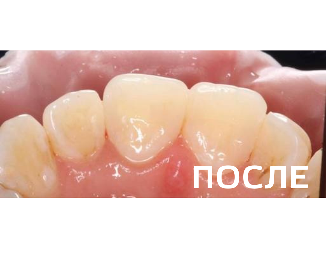 Лечение кариеса