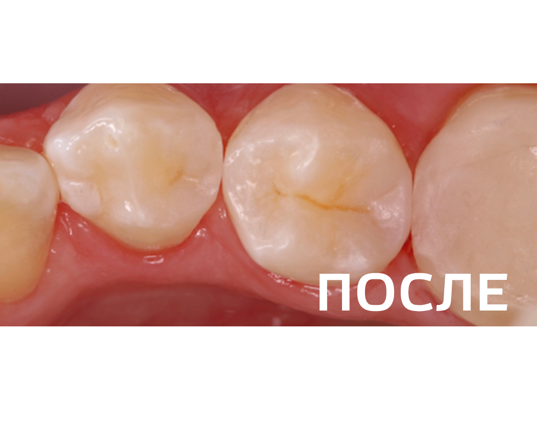 Лечение кариеса