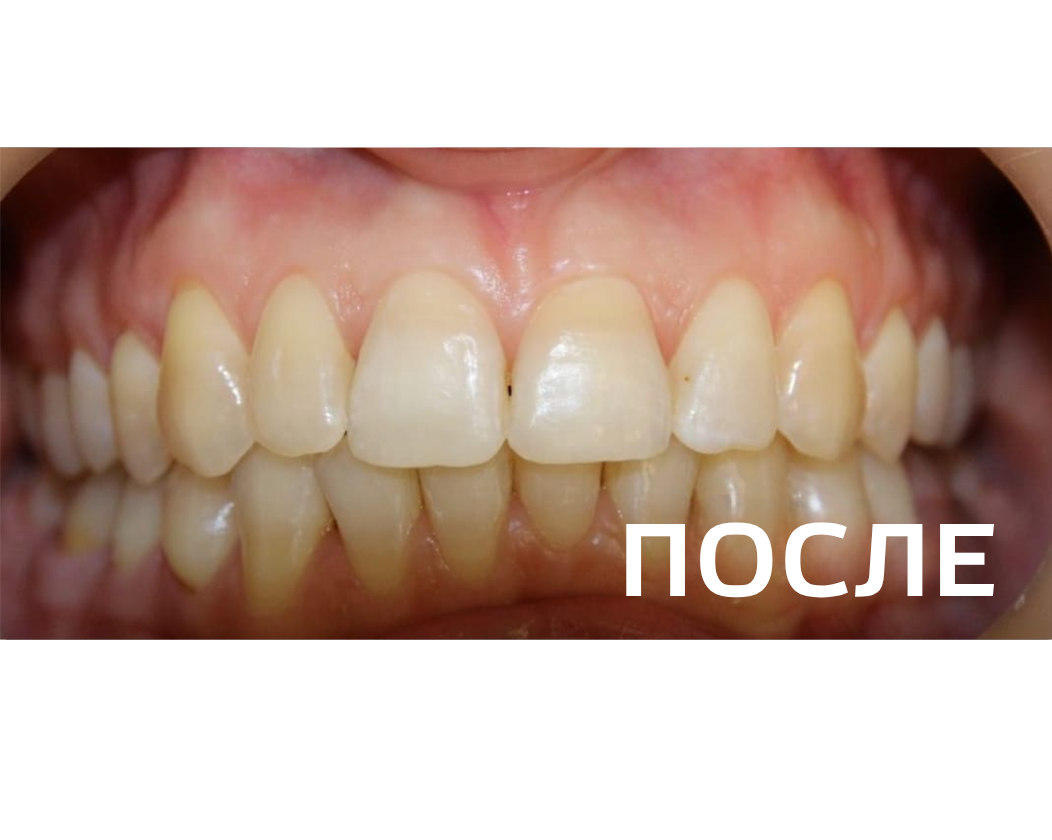 Исправление прикуса, выравнивание зубов