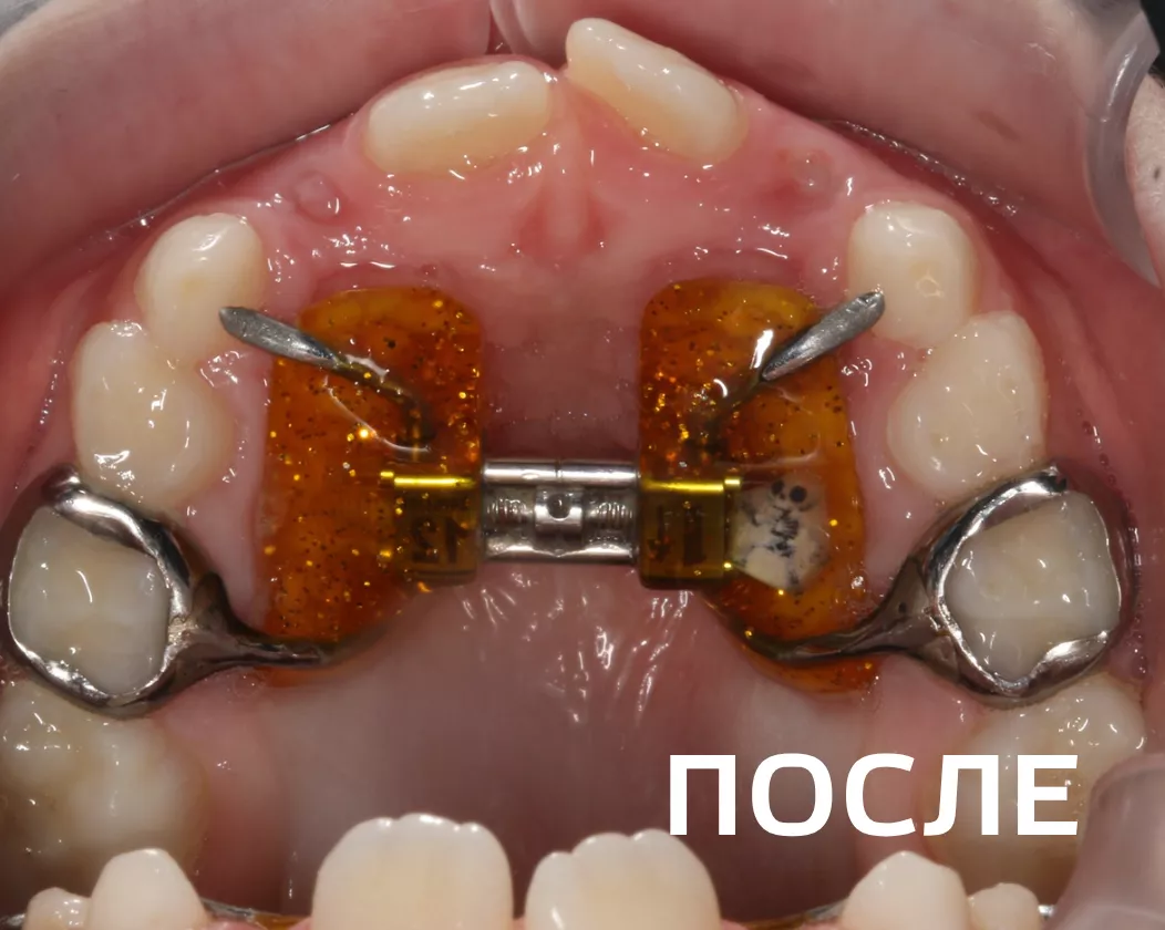 Фото после - Исправление прикуса несъемными аппаратами