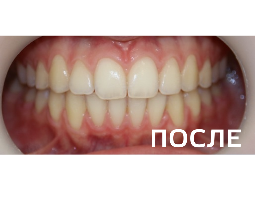 Исправление прикуса, выравнивание зубов