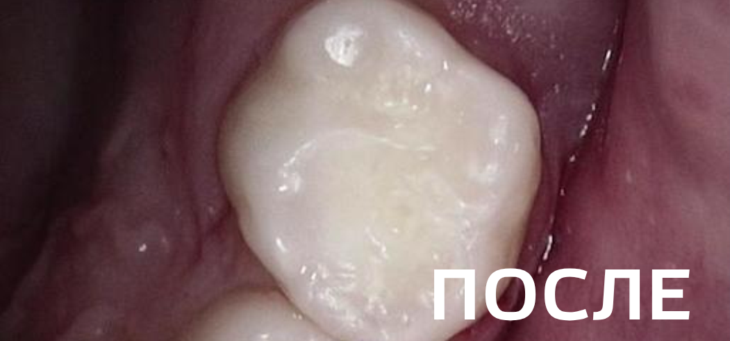 Лечение кариеса