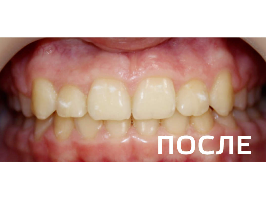 Исправление прикуса, выравнивание зубов
