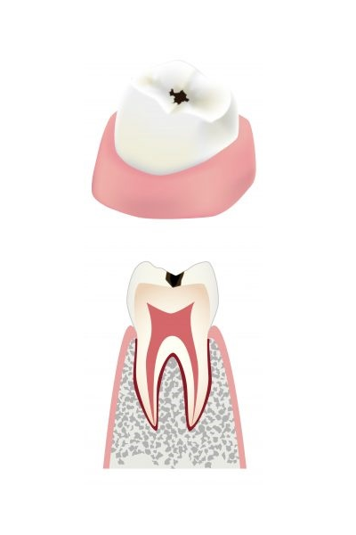 Фиссурный кариес
зуба изображение