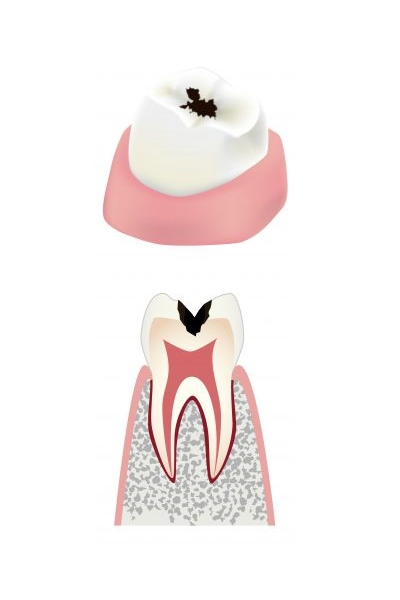 Средний кариес
зуба изображение