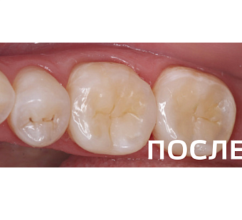 Лечение кариеса 