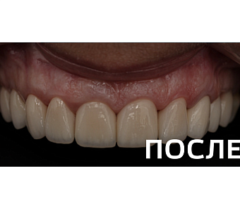 Ортопедическое восстановление фронтальной группы зубов на верхней челюсти керамическими коронками E.max