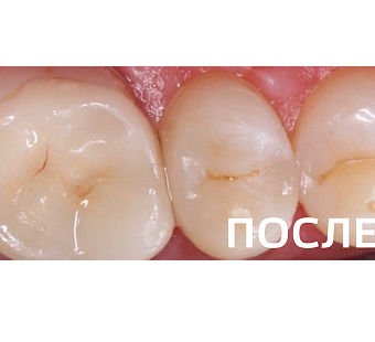 Лечение контактного кариеса