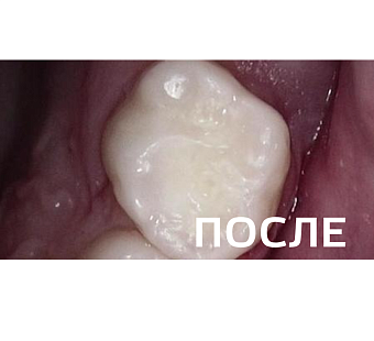 Лечение кариеса