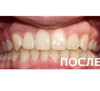 Исправление прикуса, выравнивание зубов