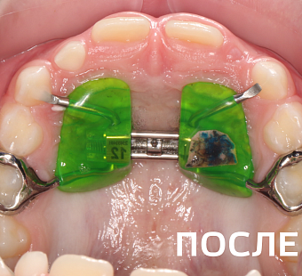 Исправление прикуса несъемными аппаратами