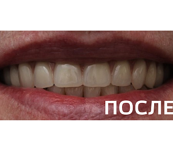 Ортопедическое восстановление зубных рядов верхней и нижней челюстей  