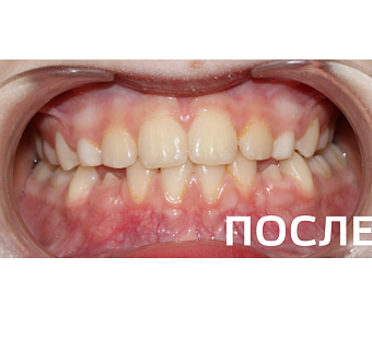 Исправление прикуса, выравнивание зубов