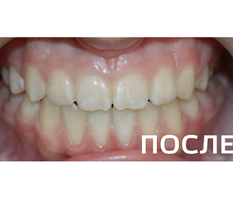 Исправление прикуса, выравнивание зубов
