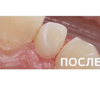 Патология dens invaginatus