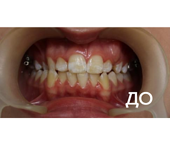 Исправление прикуса, выравнивание зубов